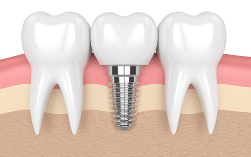 周囲の歯を守れる