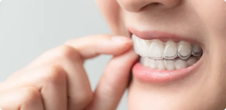 マウスピース矯正