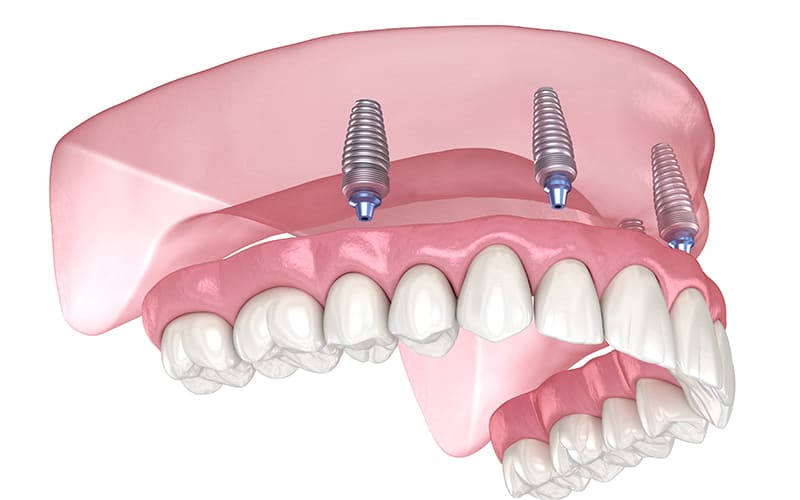 インプラントオーバーデンチャー（自費診療）